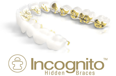 Incognito Hidden Braces